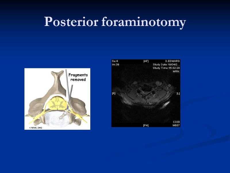Posterior foraminotomy